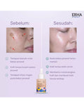 Erha Acneact Post Acne Spot Serum 30 Ml